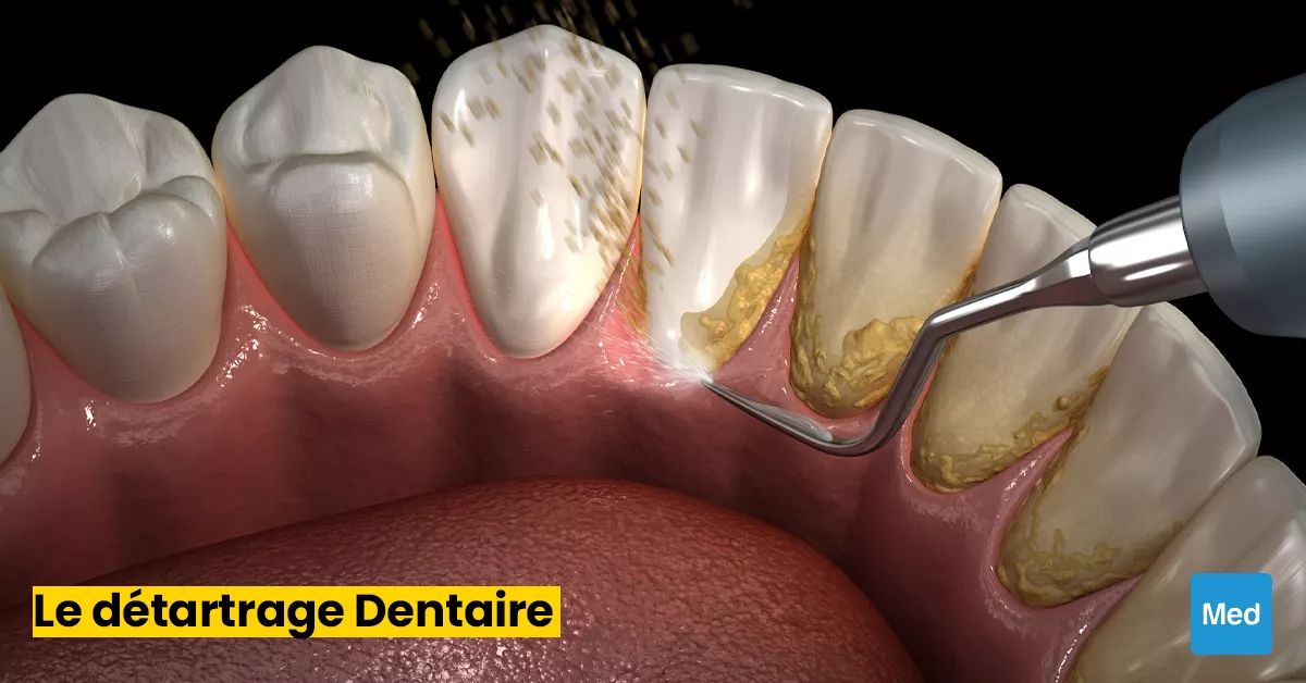 Détartrage Dentaire : Le Secret d'un Sourire Sain et Éclatant